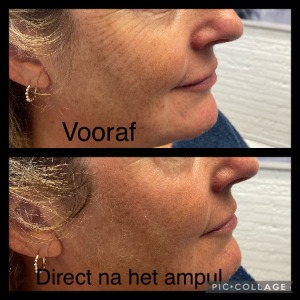 voor na ampul